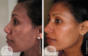 melasma